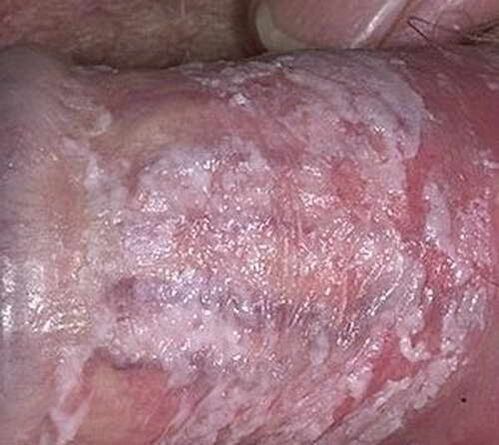 curdled discharge when excited