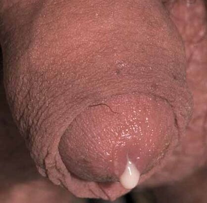 pathological discharge when excited